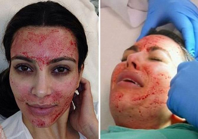 KIM KARDASHIAN vampire facial
